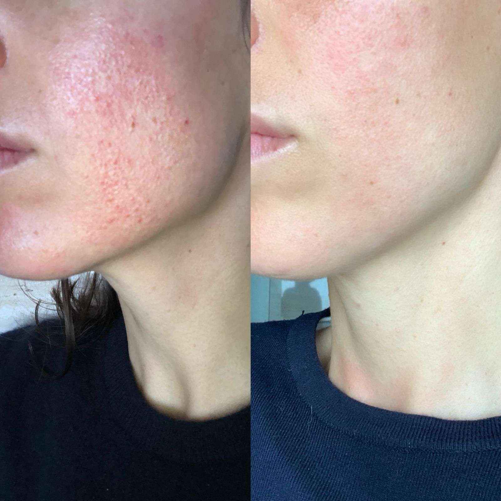 Beauté Mediterránea: ¿Maskné tras usar la mascarilla? Sérum y crema pueden ser la solución para tratarlo