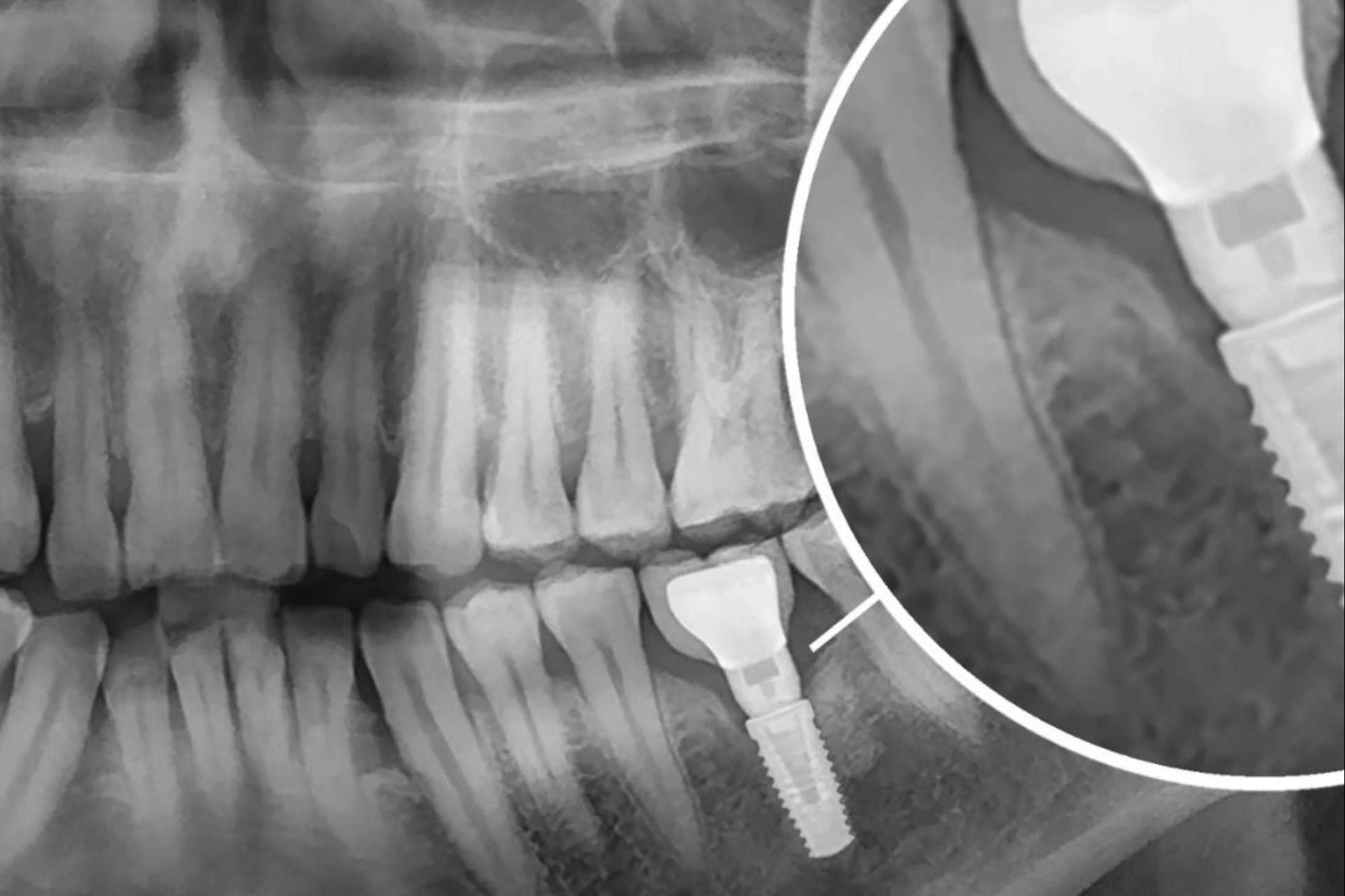 La clínica dental del Dr. Román Hernández ofrece implantes dentales para recuperar la funcionalidad de la boca