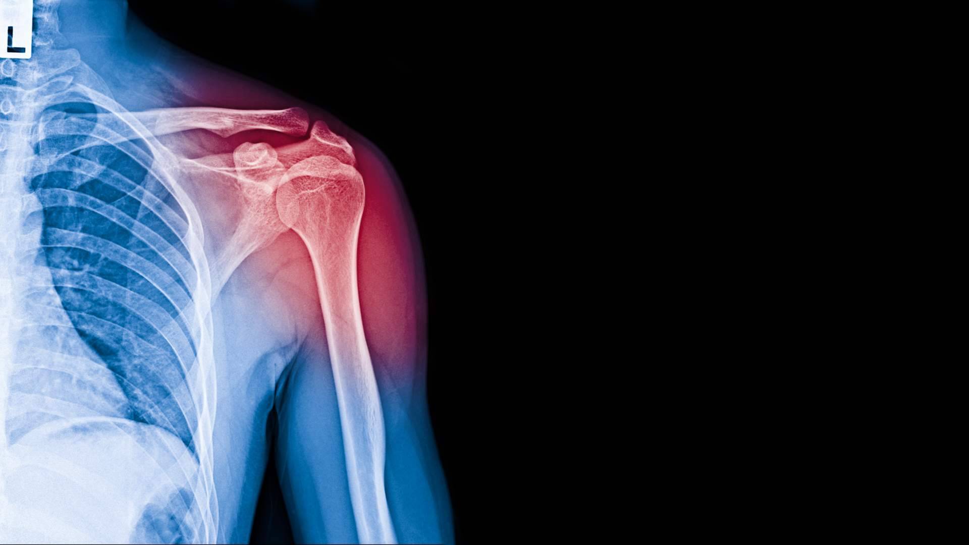 Dr. Miguel Romero explica todo lo que hay que saber sobre la tenditis de supraespinoso