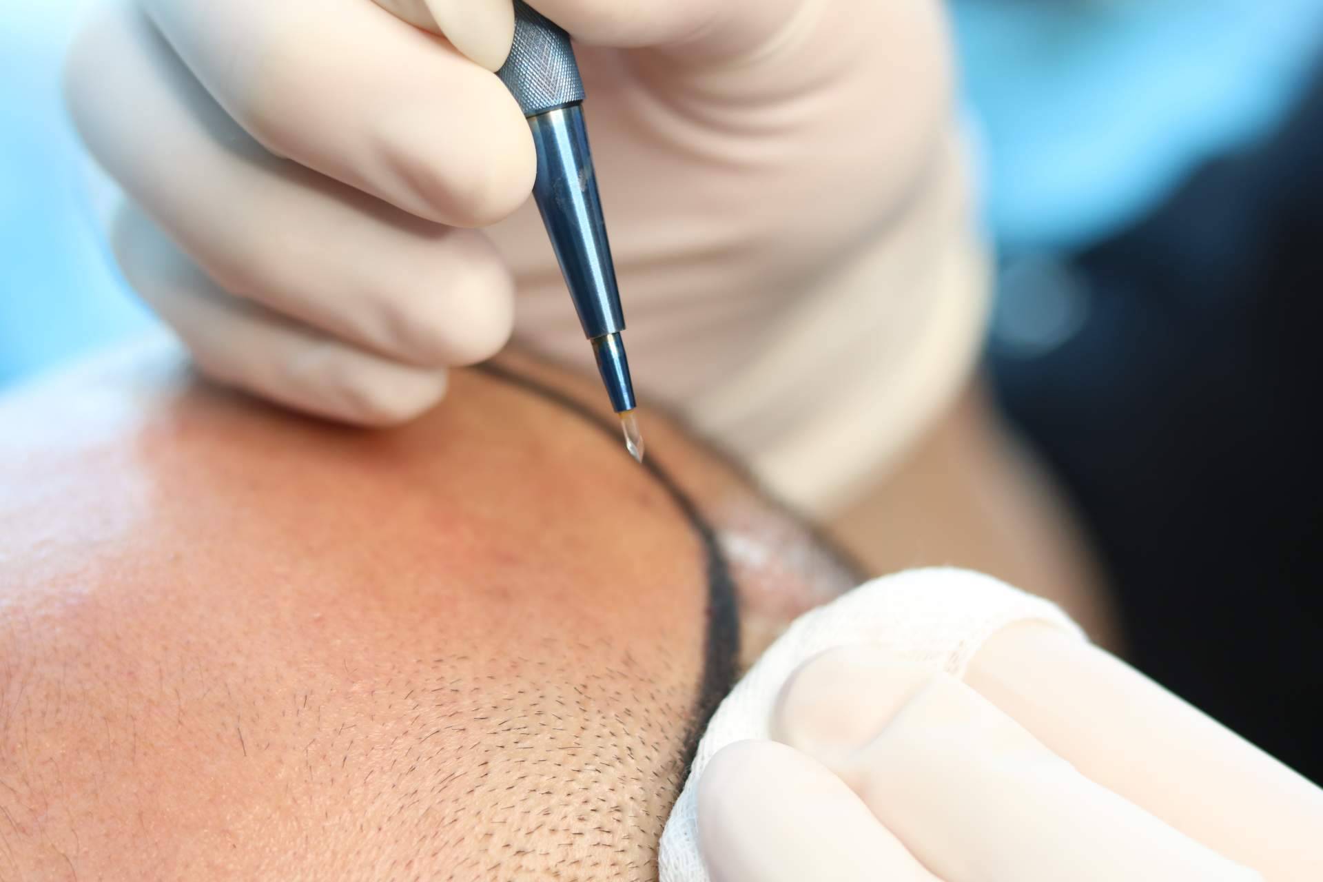 Todo lo que se debe saber sobre FUE Zafiro, la técnica de trasplante capilar masculino disponible en Capilar Innovation Clinic