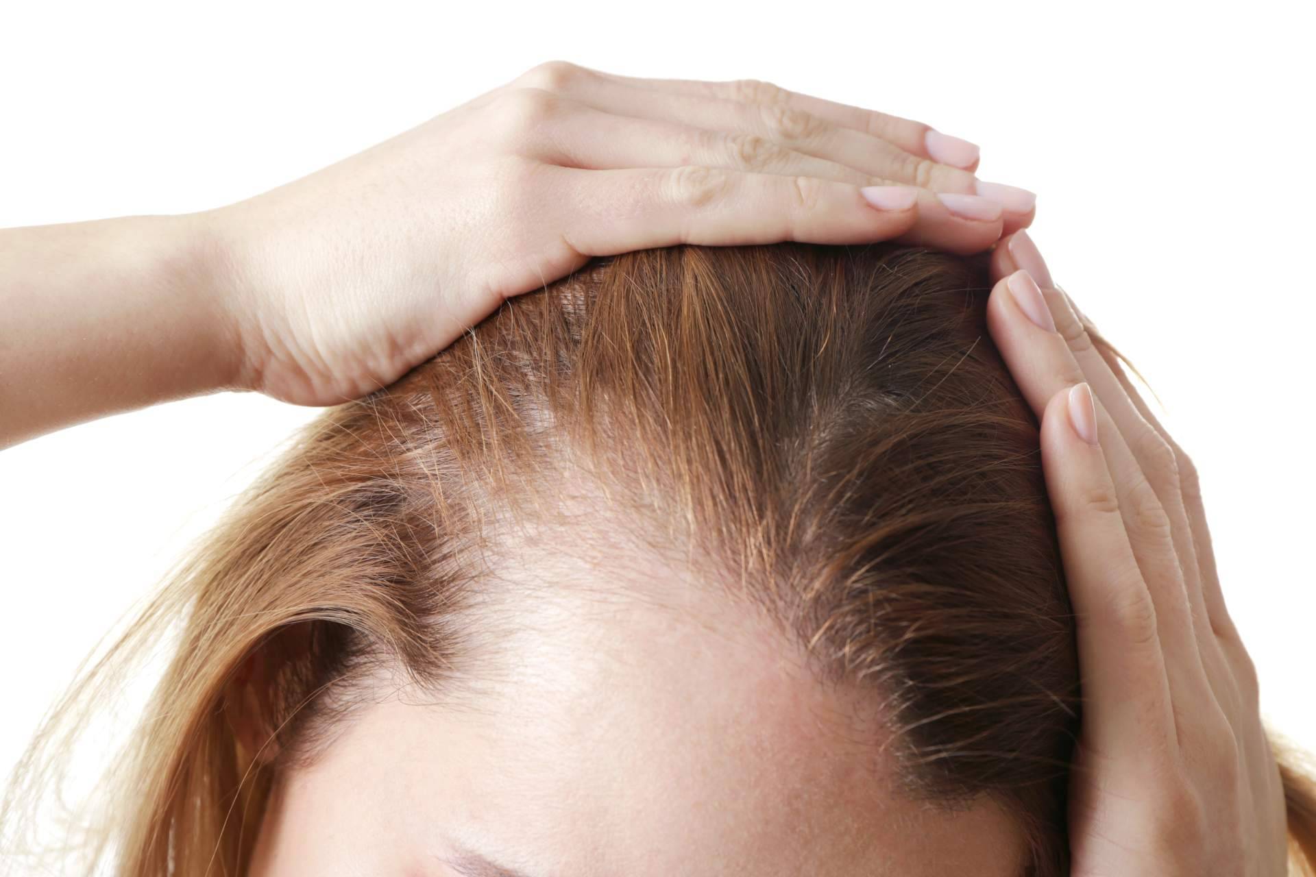 Tratamiento de la alopecia femenina con mesoterapia capilar