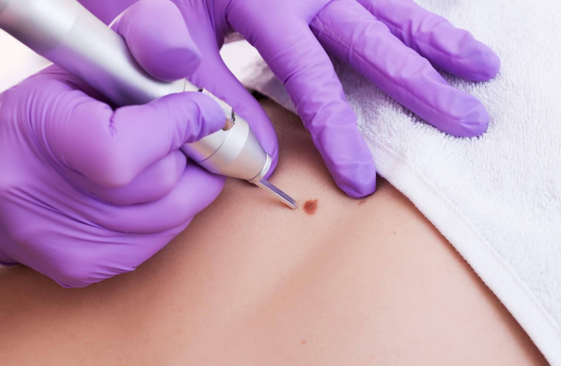 Eliminar manchas en la piel con láser con los servicios de Centro Estética El Pilar