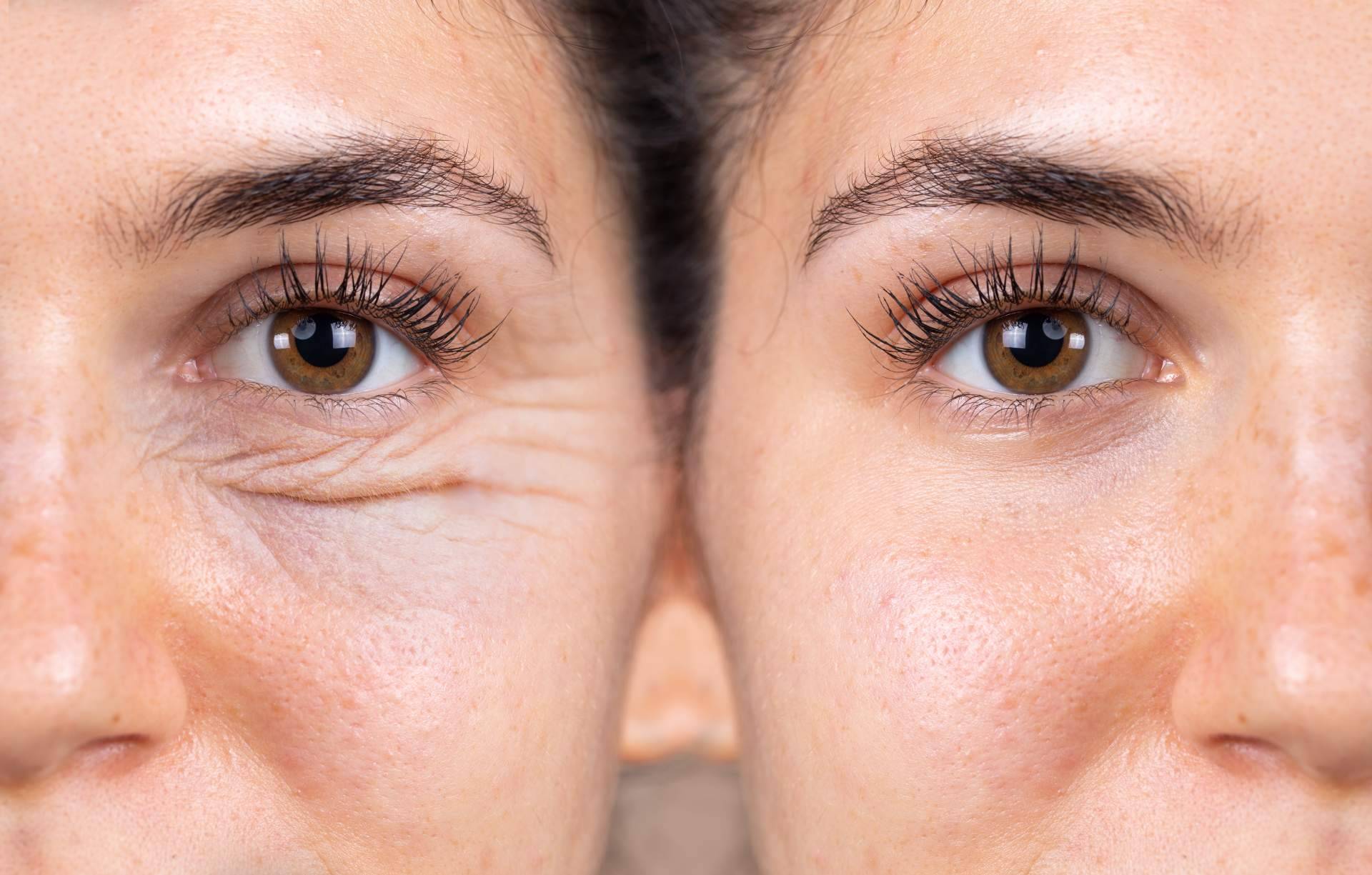 ¿Dónde realizarse una cirugía blefaroplastia? Centro Médico El Pilar