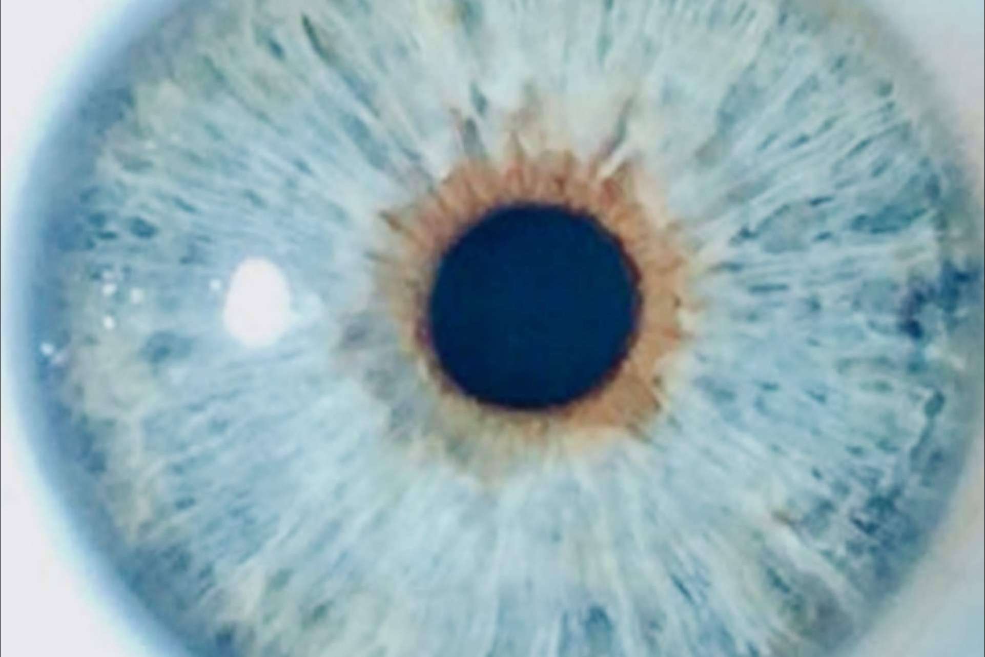 Clínica Eyecos demuestra un riesgo mínimo de glaucoma crónico después de la iridoplastia láser