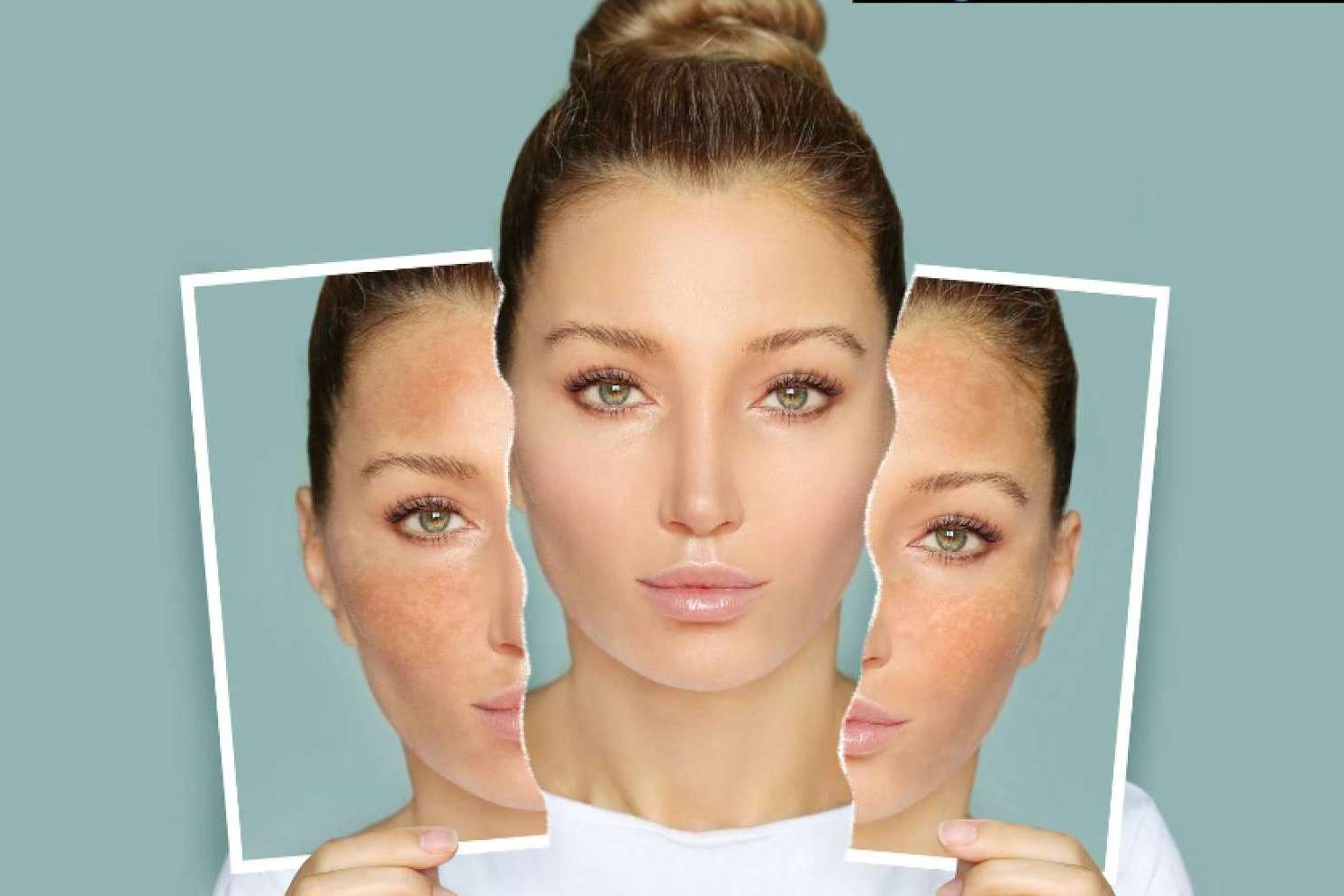 Vortex Peel, uno de los mejores peelings de alta intensidad