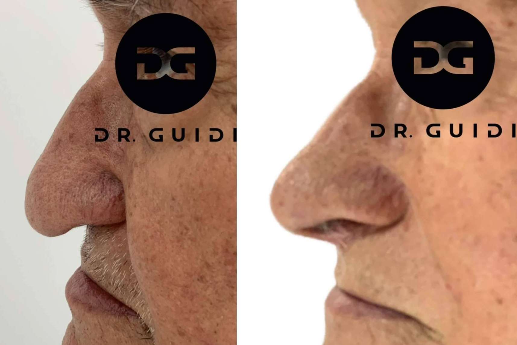 Tratamientos de rinomodelación en la clínica del Dr. Guidi