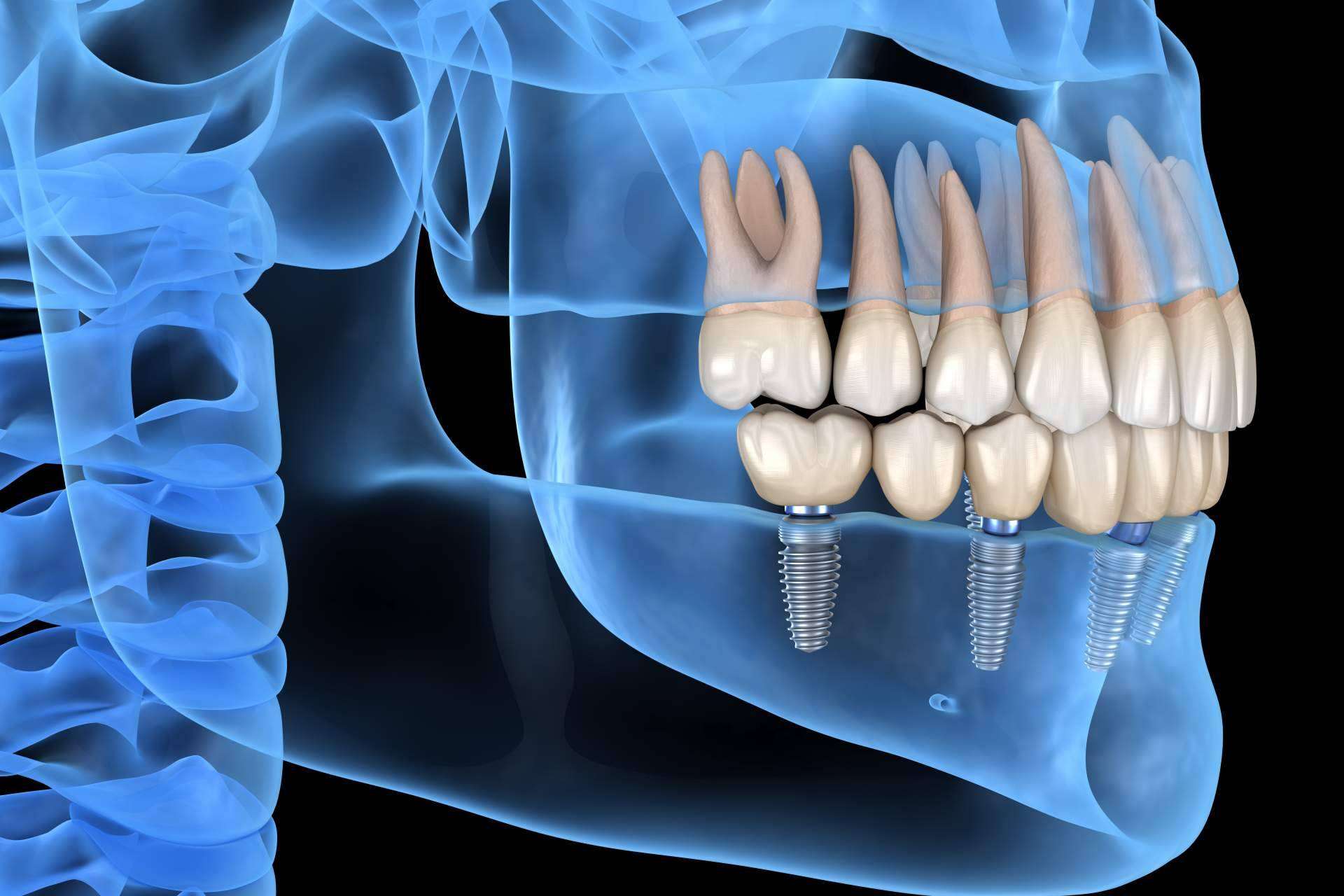 Recuperar la mejor versión de la sonrisa con los implantes dentales inmediatos de DeltaDent