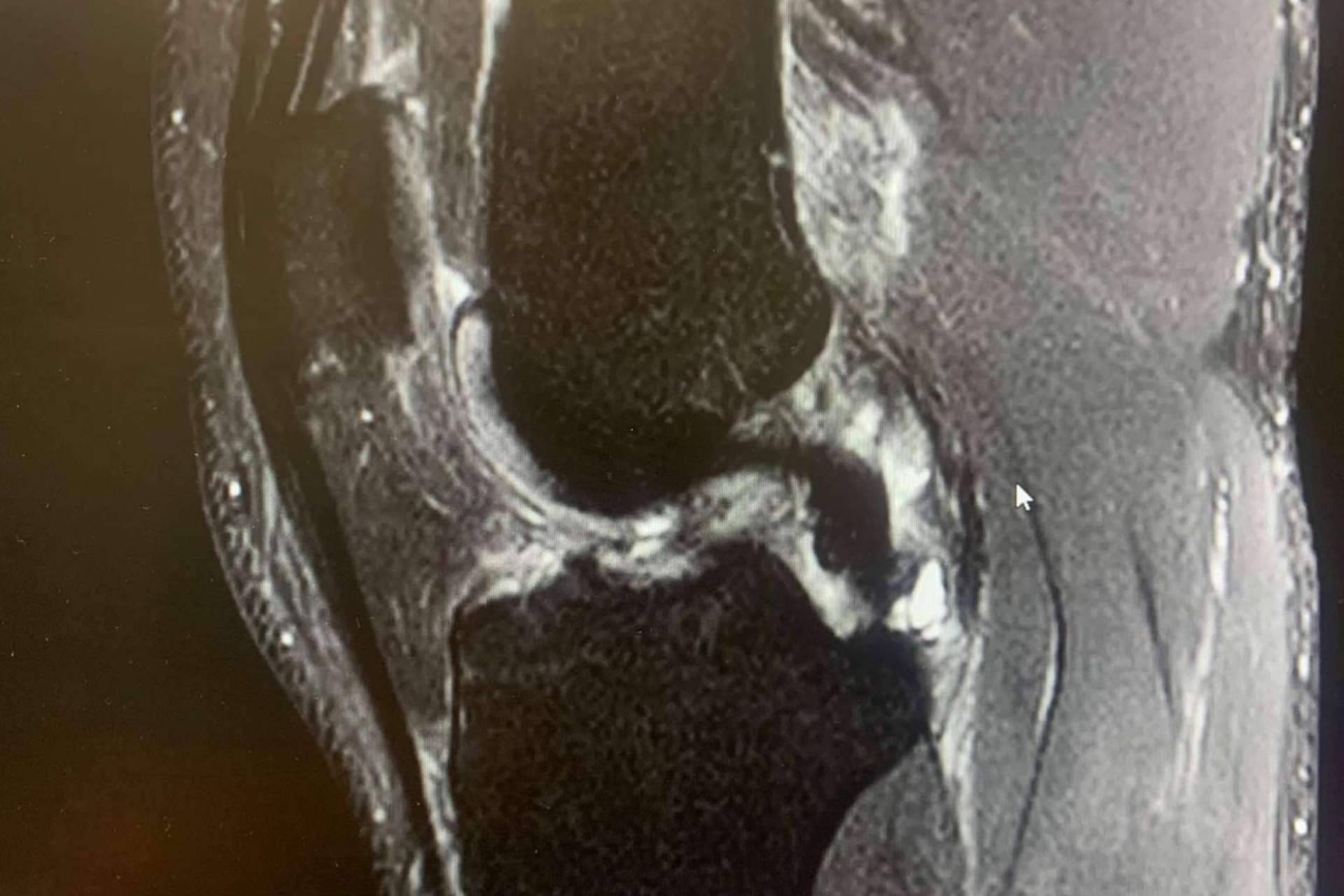 La prevención de las lesiones de ligamento cruzado anterior de la mano de Regeneractiva