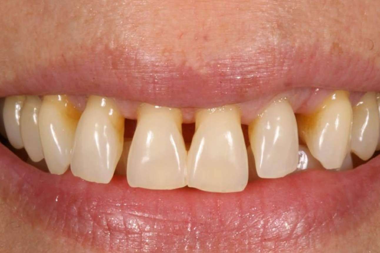 ¿Por qué es importante la prevención y el tratamiento de las enfermedades periodontales?