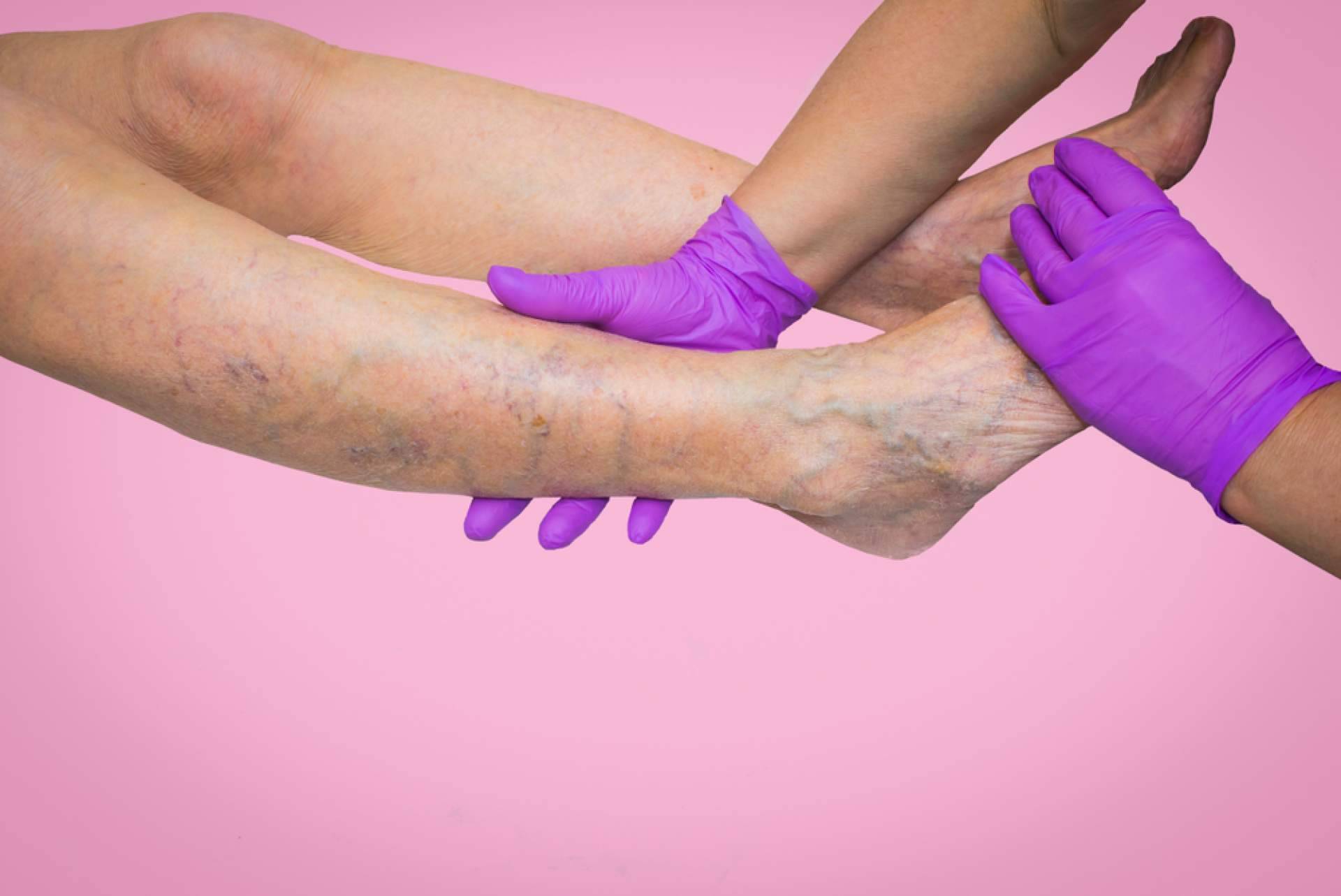 Centro Estética El Pilar, el servicio para eliminar arañas vasculares