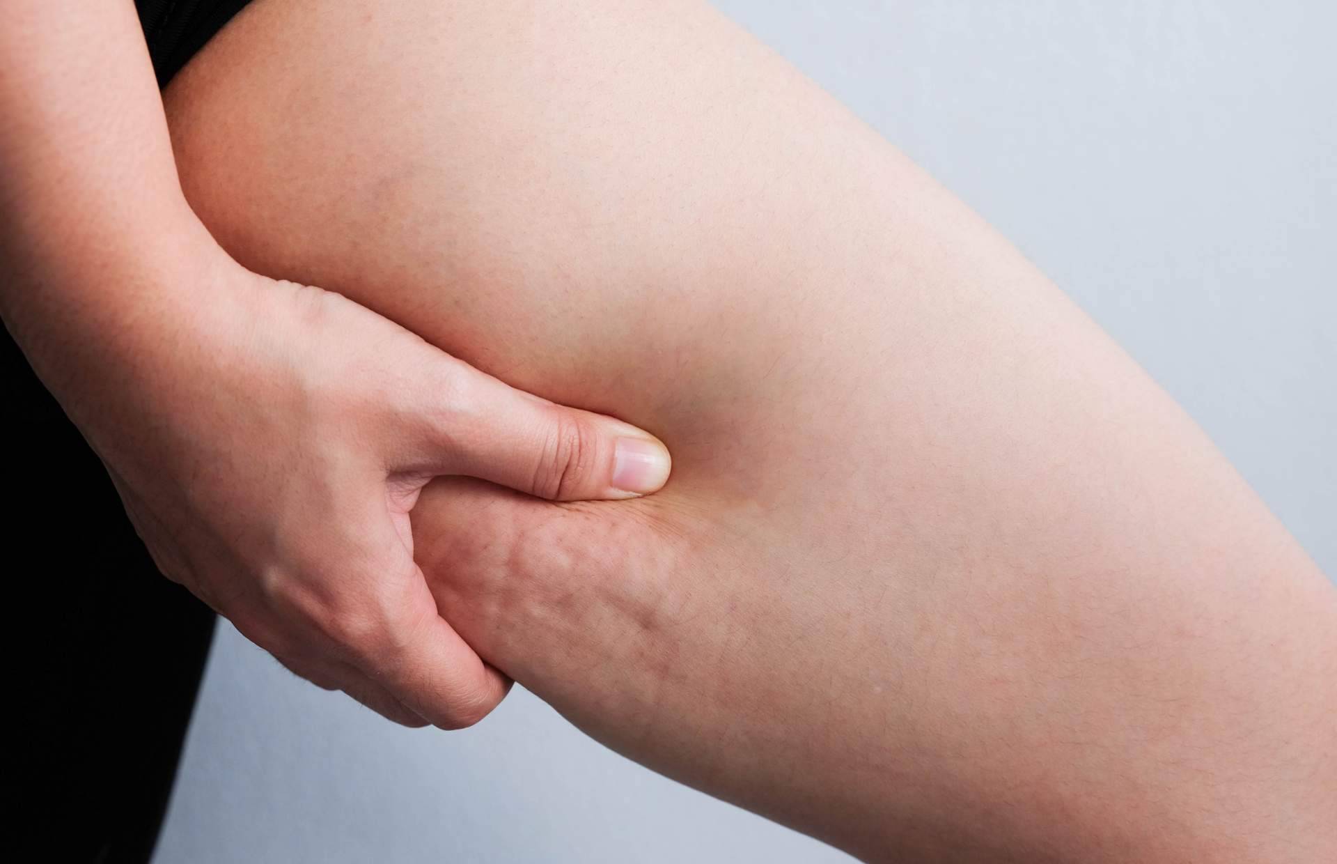 ¿En qué consisten los tratamientos anticelulíticos saludables de Cuerpo Libre?