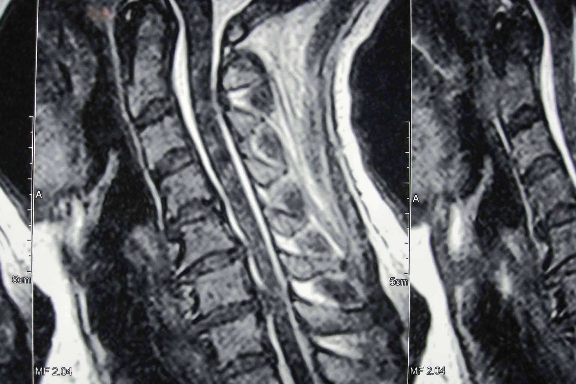 ¿Qué es la hernia disco cervical?, por Neurocirugía Galarza