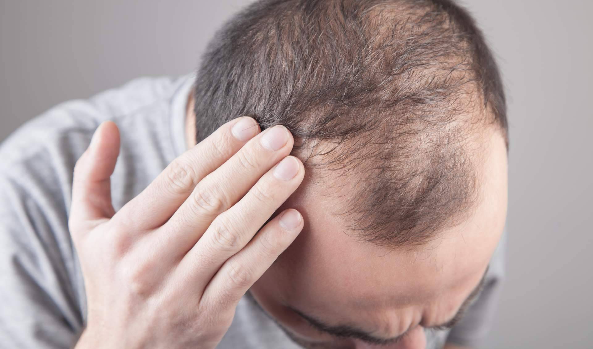 Saw Palmetto y los tratamientos para la alopecia androgénica
