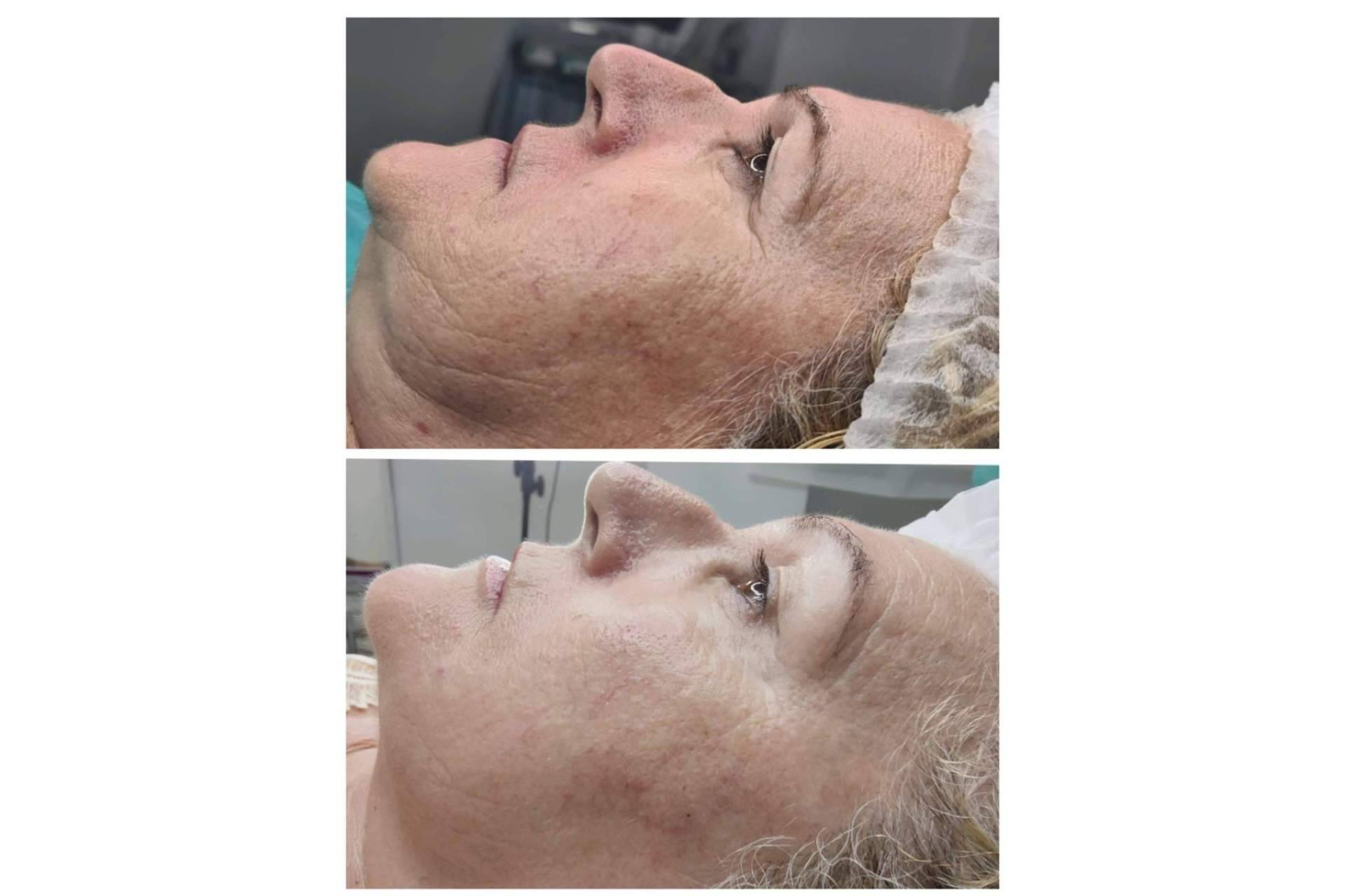 Conseguir un increíble efecto lifting con hidroxiapatita cálcica, de la mano de los expertos de la Clínica Marta Solà