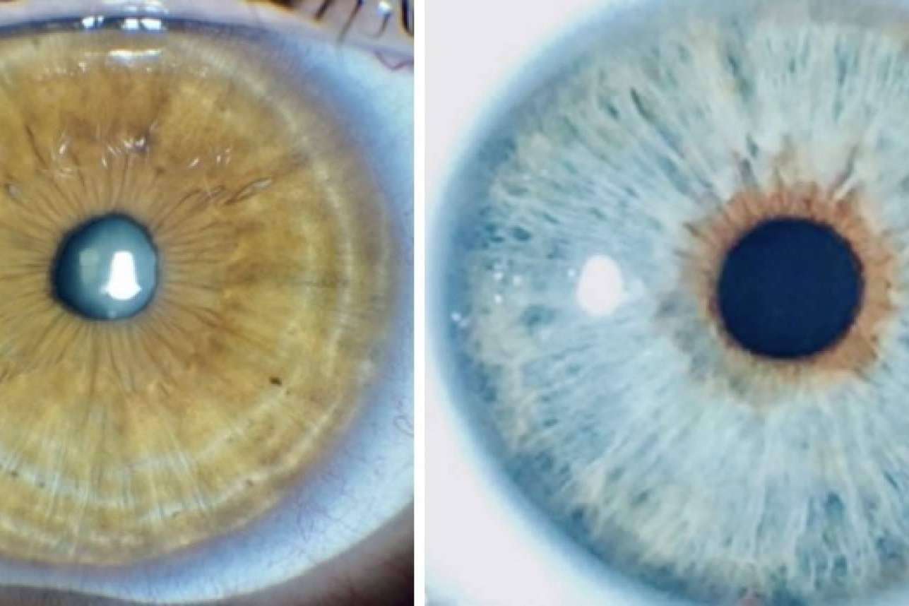 Predecir y simular en 3D el resultado del cambio de color de ojos con láser es posible con Eyecos