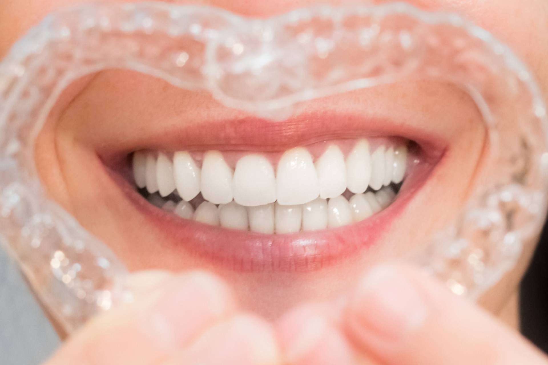 Blanqueamiento dental avanzado con luz LED para una apariencia radiante