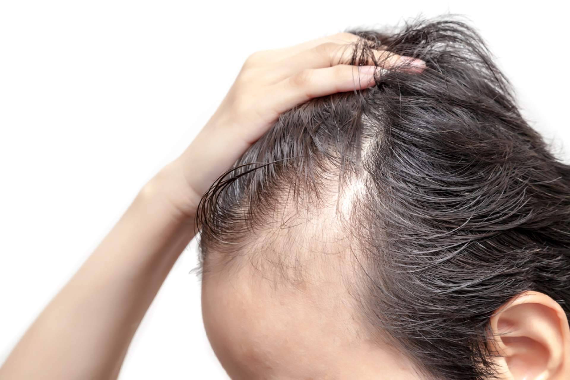 Tratamientos para la alopecia androgénica con Saw Palmetto