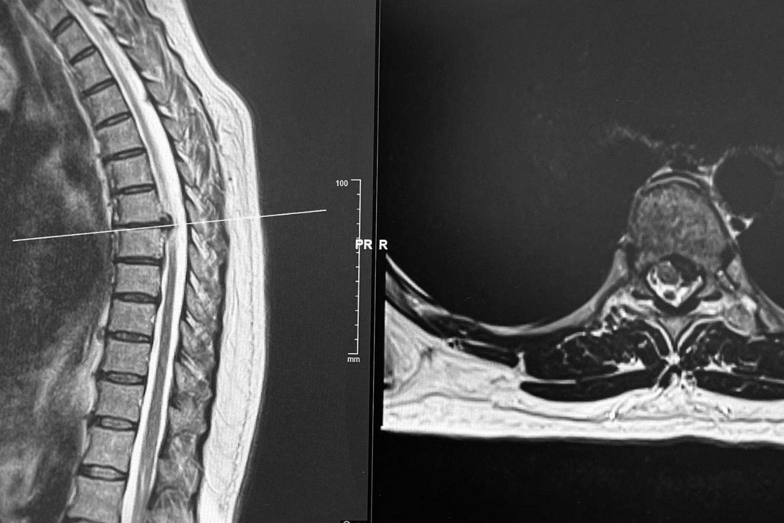 Cirugía de hernia discal con el neurocirujano especialista Dr. Carlos Botella-Asunción