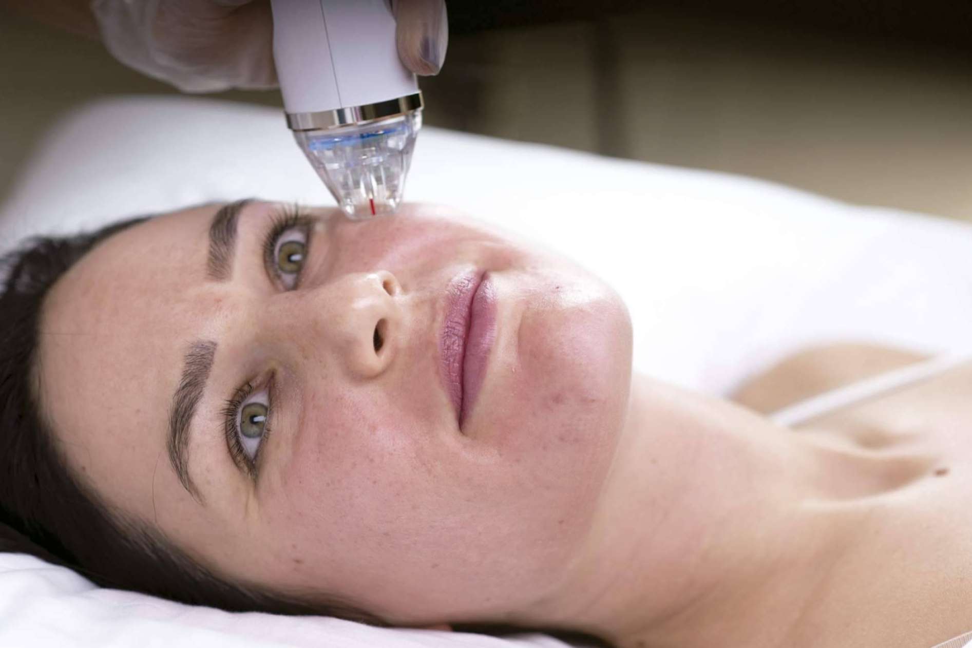 Mejorar la piel del rostro es posible con la técnica de resurfacing facial de Alluring Clinic