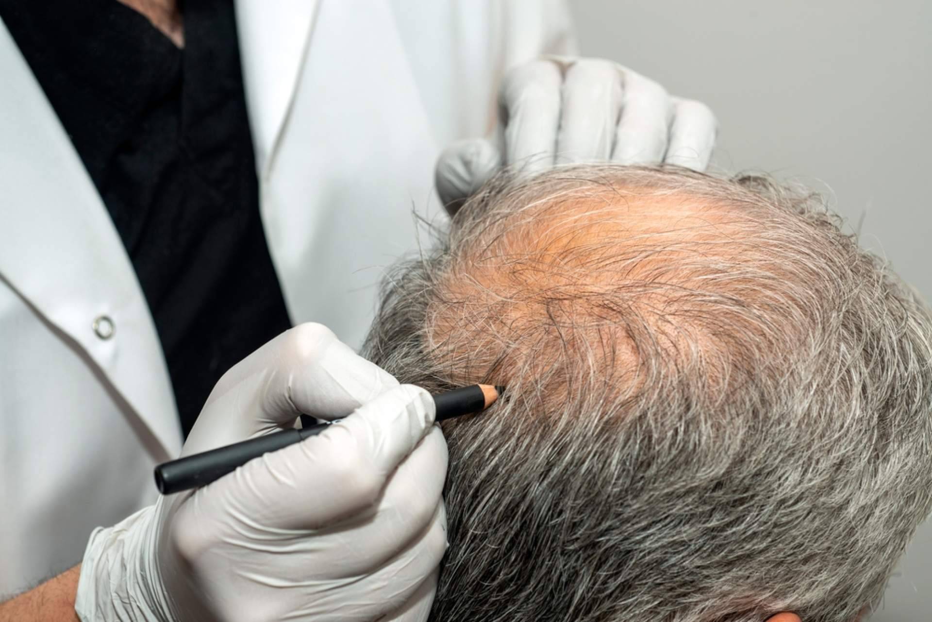 Trasplante capilar con efecto natural en 6 meses; la fórmula exclusiva del Dr. Aníbal Mora marca la diferencia