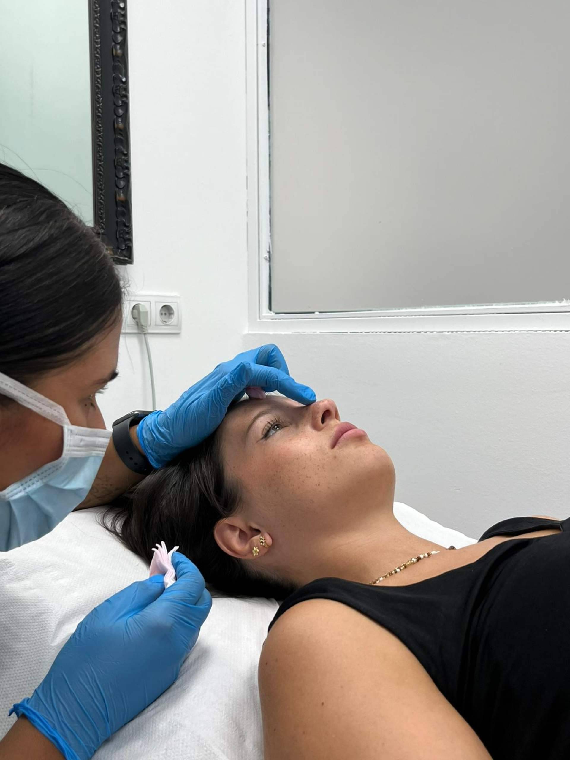 Cómo eliminar el código de barras; las arrugas del labio superior que la medicina estética corrige con ácido hialurónico