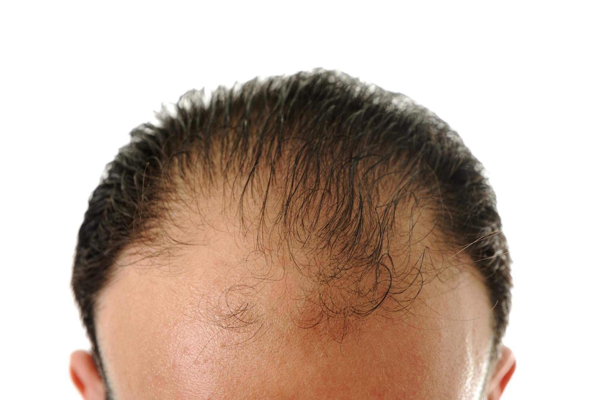 Evocapil, marca especializada en salud capilar, amplía su catálogo con fórmulas avanzadas contra la alopecia