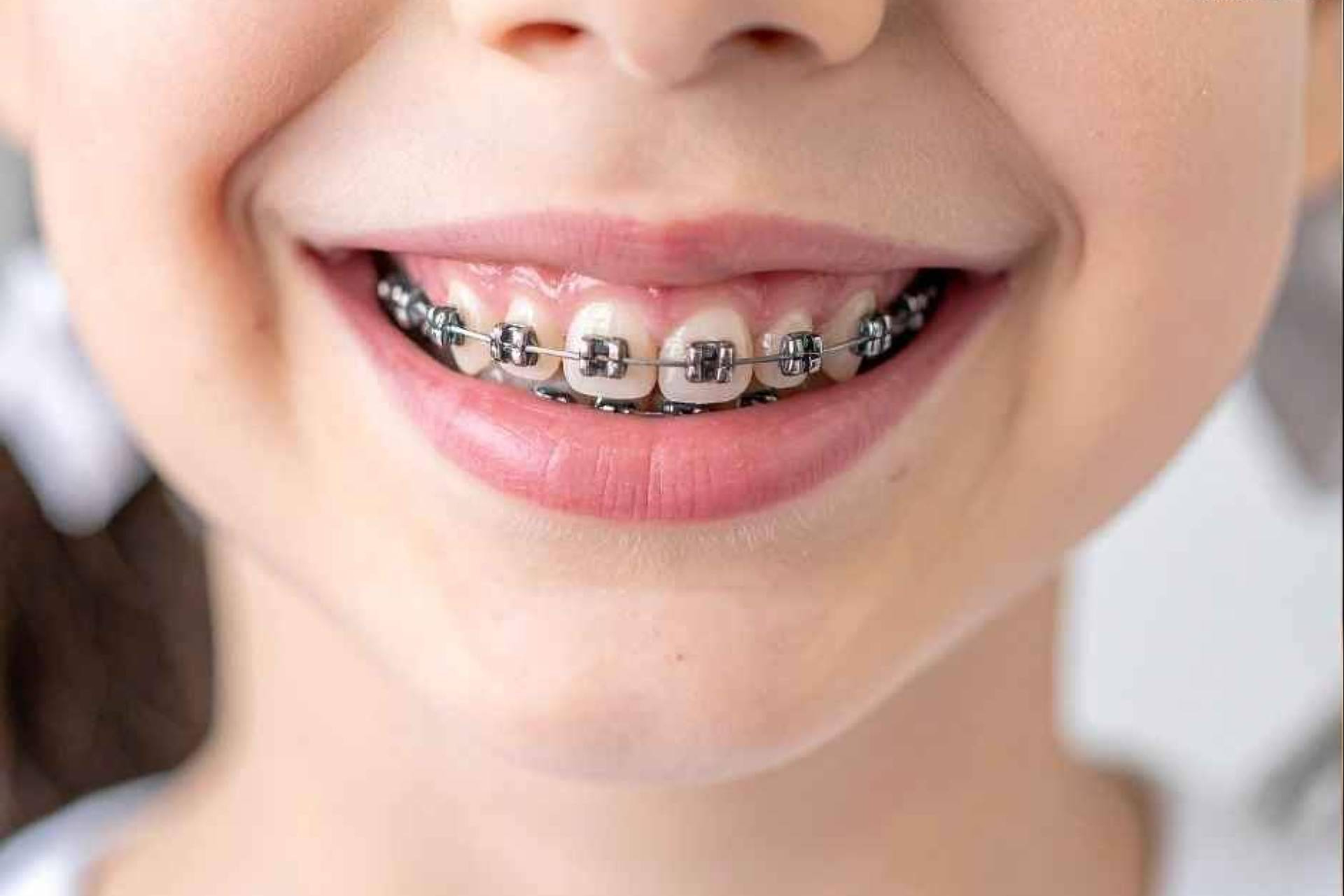 Ortodoncia infantil; guía para una sonrisa saludable desde pequeños