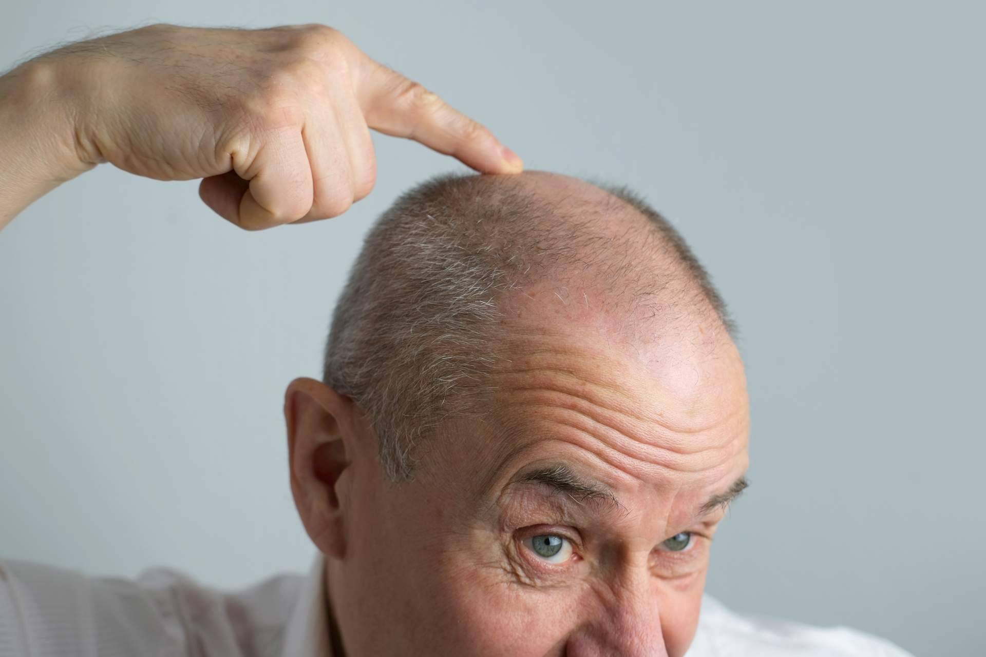 Xpecia Hombre, el suplemento que frena la caída del cabello y refuerza su crecimiento desde el interior