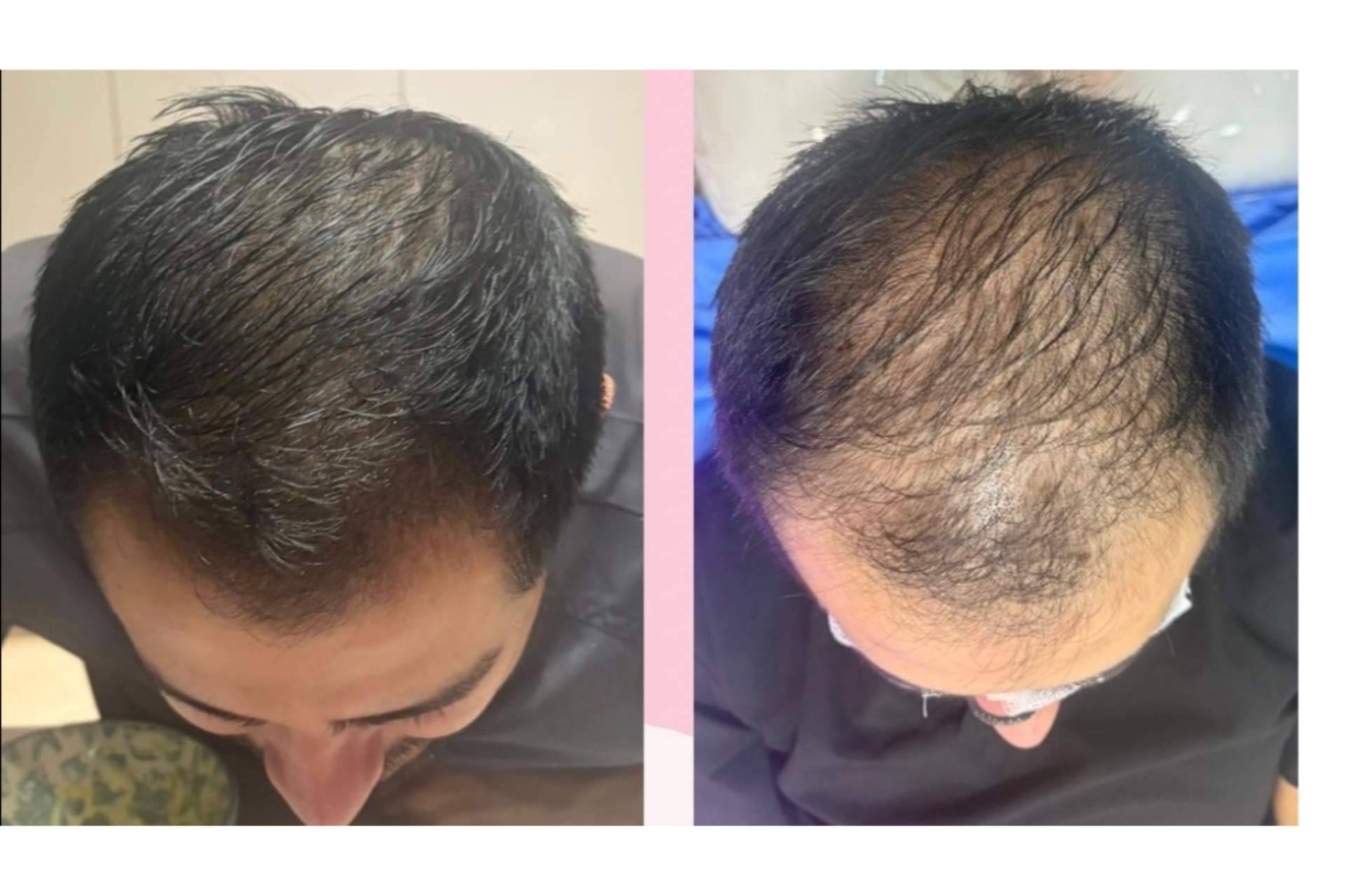 Alopecia androgenética y caída de cabello, qué esperar de los tratamientos en 2027